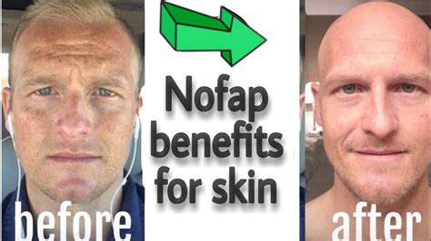 does nofap improve skin